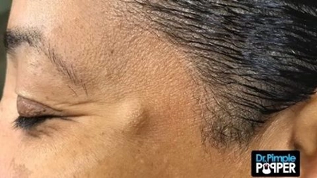 I-a aparut o umflatura pe tampla, sub piele. Cand a ajuns la medic, acesta a avut un adevarat SOC. Ce a VAZUT dupa ce i-a facut o incizie