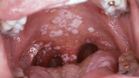 Cauza principala a aparitiei cancerului o constituie infectiile cu candida! Bicarbonatul de sodiu este remediul perfect