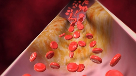 Care sunt valorile normale ale colesterolului si ce simptome apar cand e prea mare