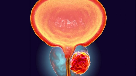 Consumul de ciuperci reduce riscul de cancer de prostată