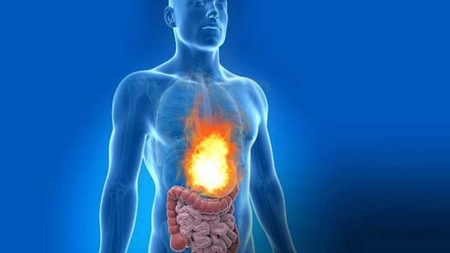 Aciditatea gastrică: 5 remedii naturale care combat arsurile la stomac