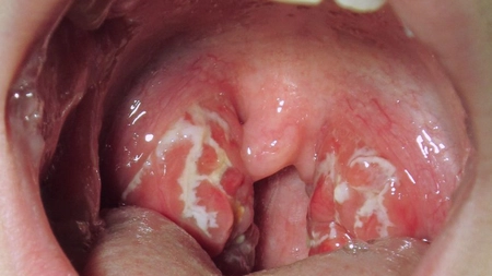 Cum sa faceți singuri bomboane pentru dureri în gât