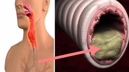 Cum scapi de flegma acumulată în nas sau gât