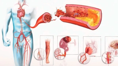Care sunt cele 12 simptome ale atacului vascular cerebral?