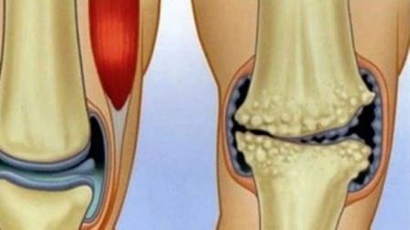 Cu ce remedii scapi de durerile de genunchi