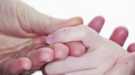 Cum să scapi de negi fără tratamente scumpe, la tine acasă