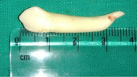 Din gura unui student tocmai a fost scos cel mai lung dinte vazut vreodata