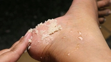 Călcâie crăpate. Cum le tratezi eficient. Metode de la dermatolog