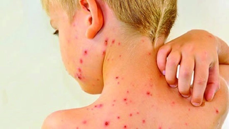 Afecțiunea care a ucis 64 de români ocolește Iașul! A fost înregistrat doar un caz în ultimele câteva săptămâni