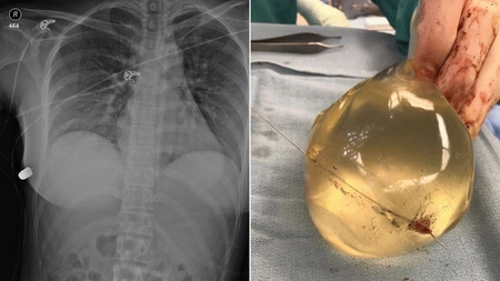 O femeia a fost împușcată în piept. Silicoanele au salvat-o de la moarte! - FOTO