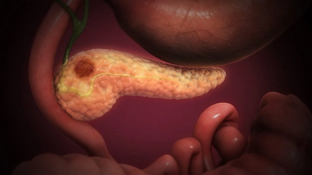 Cancerul pancreatic: primele simptome