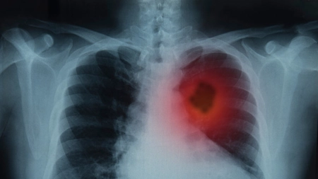 O femeie de 39 de ani a murit de coronavirus, deși nu avea alte boli