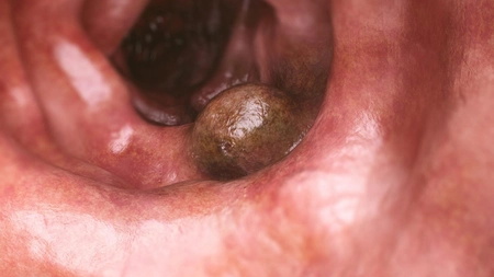 Cancer: 4 obiceiuri bune care reduc riscul