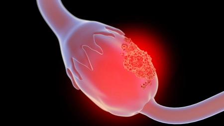 Simptomele cancerului ovarian: ascită, sângerari, dureri