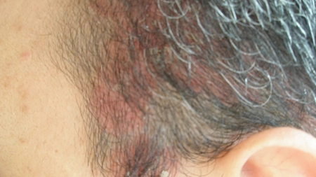 Tratamentul dermatitei seboreice: igiena este cea mai importanta