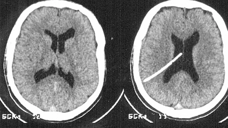 Care sunt cauzele edemului cerebral