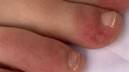 Unii pacienți cu coronavirus pot prezenta erupții și leziuni ale pielii