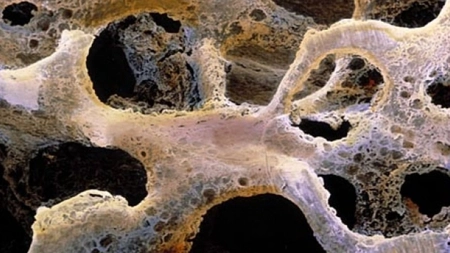 Soia poate ajuta la combaterea cancerului osos