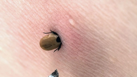 Ieșenii au trecut cu bine peste sezonul căpușelor! În cele trei luni de vară, la UPU de la Spitalul 