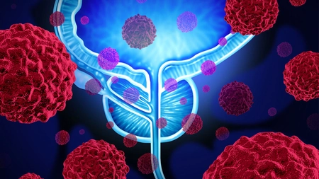 Cancerul de prostată: primele simptome