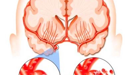 De ce putem avea accidentele vasculare cerebrale