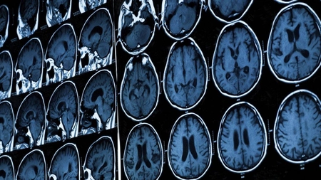Studiu: Schizofrenia, al doilea cel mai important factor de risc pentru deces asociat COVID-19, după vârstă