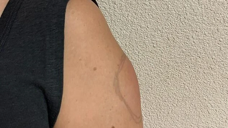„Braţ Covid”, efectul advers rar apărut după administrarea vaccinului Moderna. Ce spun medicii
