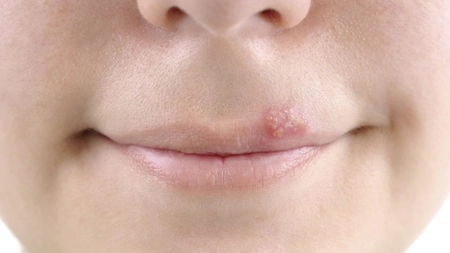 Herpes: 4 soluții naturale pentru vindecare