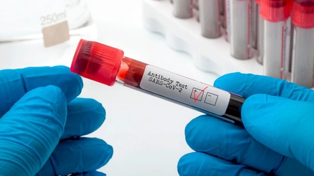 Cât durează anticorpii după infecţia cu SARS-CoV-2? Iată răspunsul medicului Virgil Musta