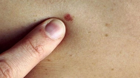 Remedii naturale pentru a scăpa de alunițe. Aceste metode eficiente sunt la îndemâna tuturor