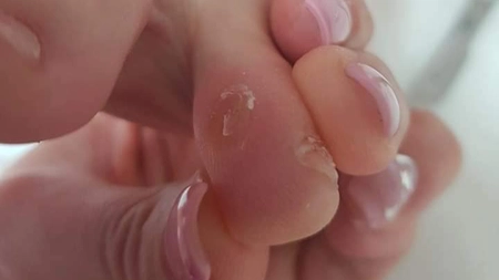 Bătătura „ochi de găină“: Ce reprezintă și cum poate fi tratată