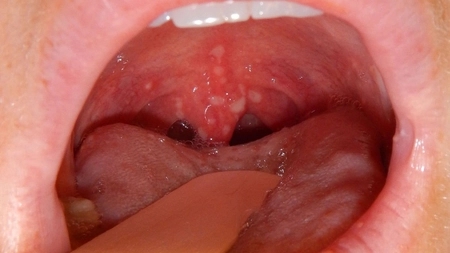 Afte în gât: Prevenirea și tratarea acestora