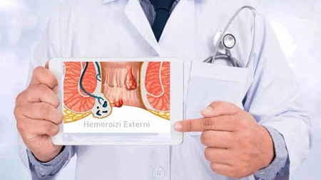 Leacuri bătrânești pentru hemoroizi externi: Remedii naturale pentru boala hemoroidală