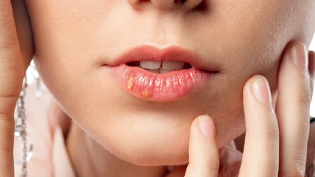 Herpes oral: Cum se tratează în perioada sarcinii