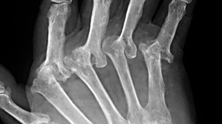 Ce este artrita psoriazică: Simptome și tratament