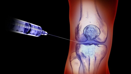 Injecții pentru reumatism: Tratamentul durerilor articulare