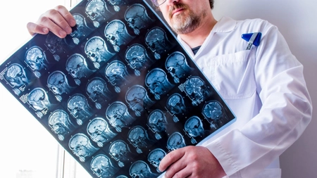 Leac pentru epilepsie: Cum poți scăpa de această afecțiune 
