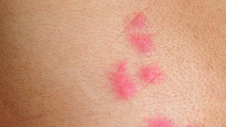 Ciupitura de purice: Cum să identifici rapid mușcătura insectei