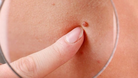 Imagini negi cancerigeni. Primele semne că suferi de virusul HPV