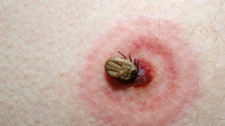 Mușcătură de căpușă poze: Cum să acționezi la timp pentru a îndepărta insecta