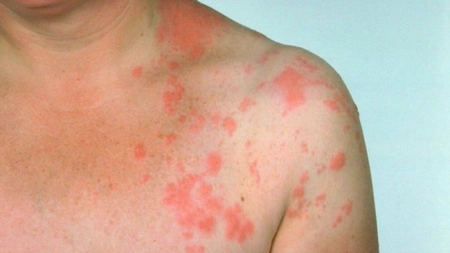 Tipuri de dermatită poze. Când debutează afecțiunea și cum să o identifici la timp