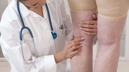 Ce medic tratează varicele? Află unde trebuie să mergi dacă te confrunți cu această afecțiune