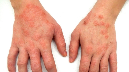 Am scăpat de eczemă. Ce presupune terapia pentru vindecare și cum să prelungești starea de remisie