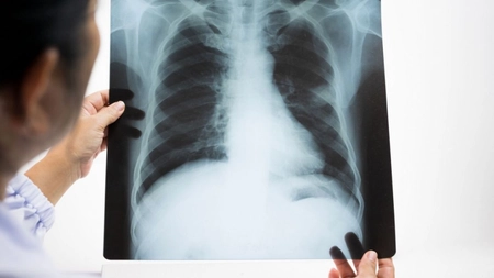Ce înseamnă opacitate pulmonară? Iată la ce se referă termenul și cum se clasifică
