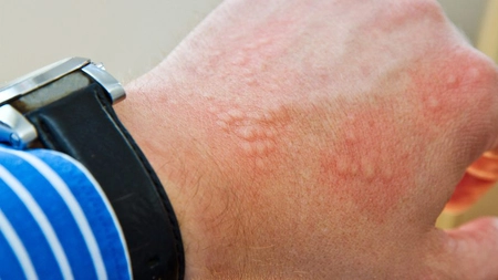 Bubițe pe mâini poze. Factorii care influențează apariția unei probleme dermatologice