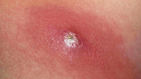 Infecția cu stafilococ auriu. Cauze, simptome, tratament și poze cu temuta bacterie