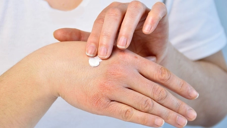 Dermatita de contact: poze, cum se manifestă și când este cazul să mergeți la medic
