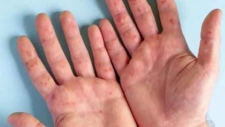 Care sunt simptomele Gripei tomatelor. Noua boală foarte contagioasă din India