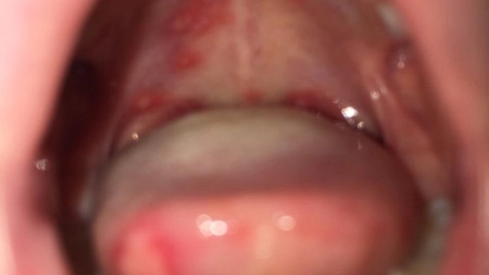 Herpangina poze. Cum să reduci rapid inflamația din gât