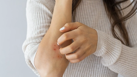 Ce este eczema și ce tratament recomandă medicii pentru ameliorarea simptomelor? Iată cum prepari un unguent eficient acasă